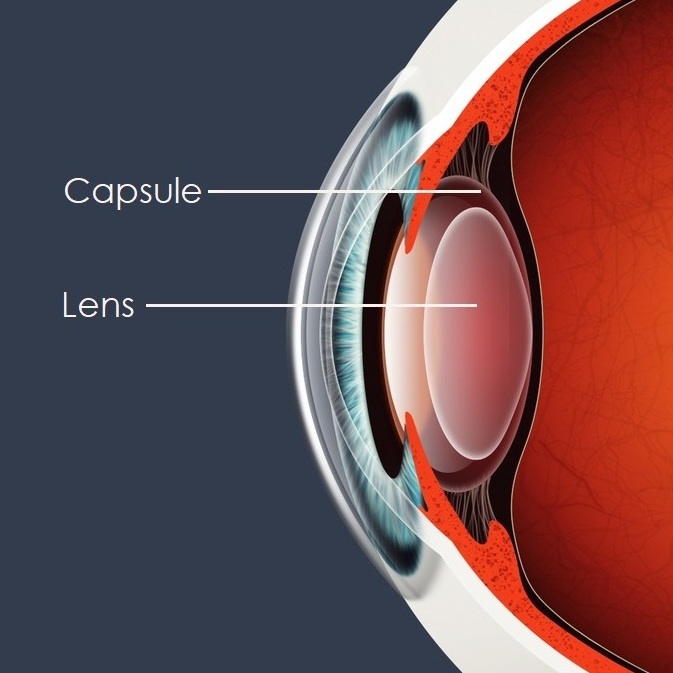 YAG Laser Capsulotomy Treatment Laser Eye Surgery Birmingham