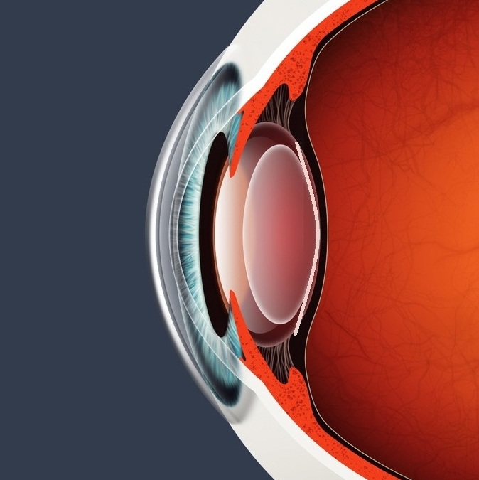 YAG Laser Capsulotomy Treatment Laser Eye Surgery Birmingham